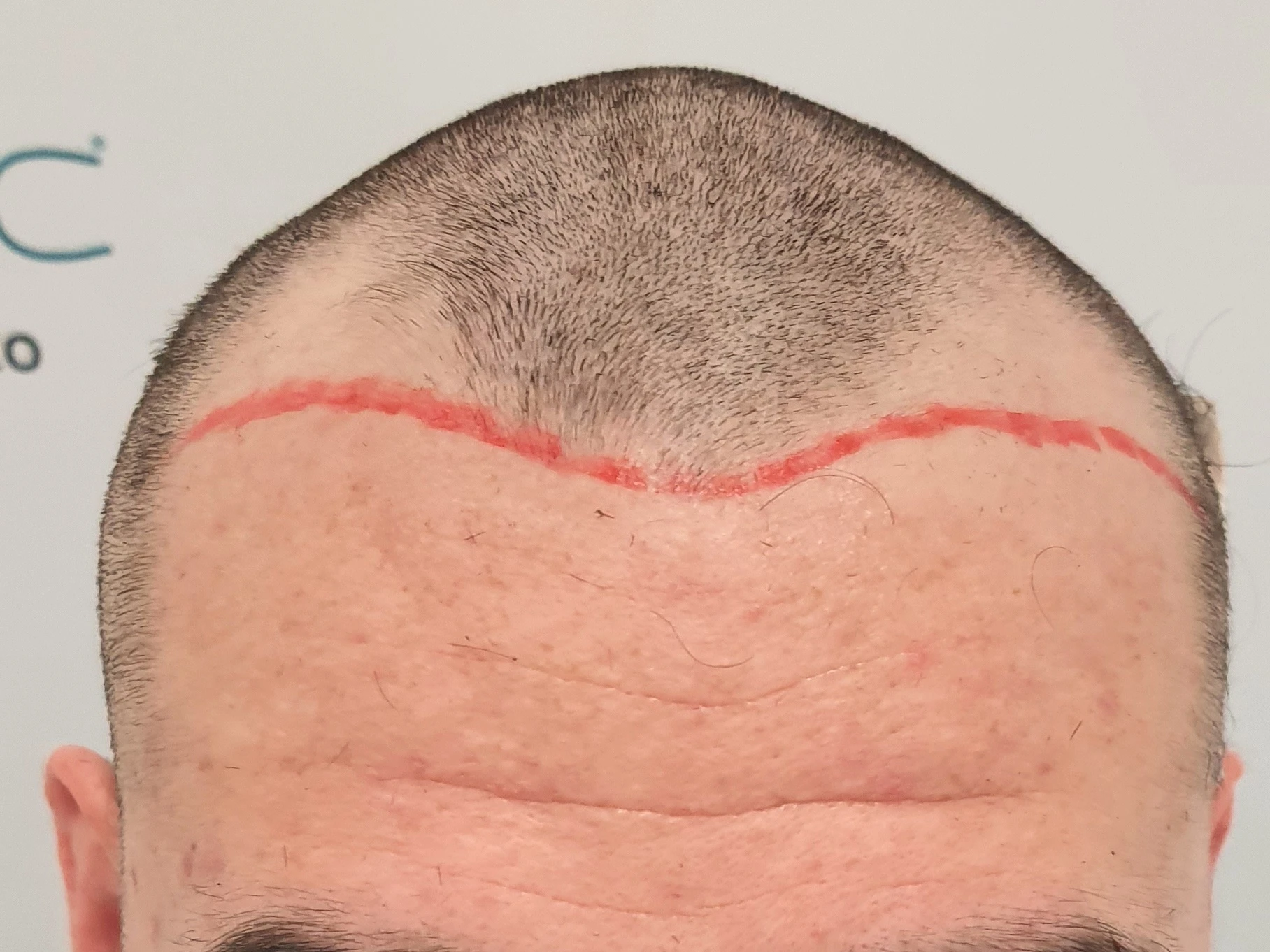 Prima - Ricostruzione linea frontale