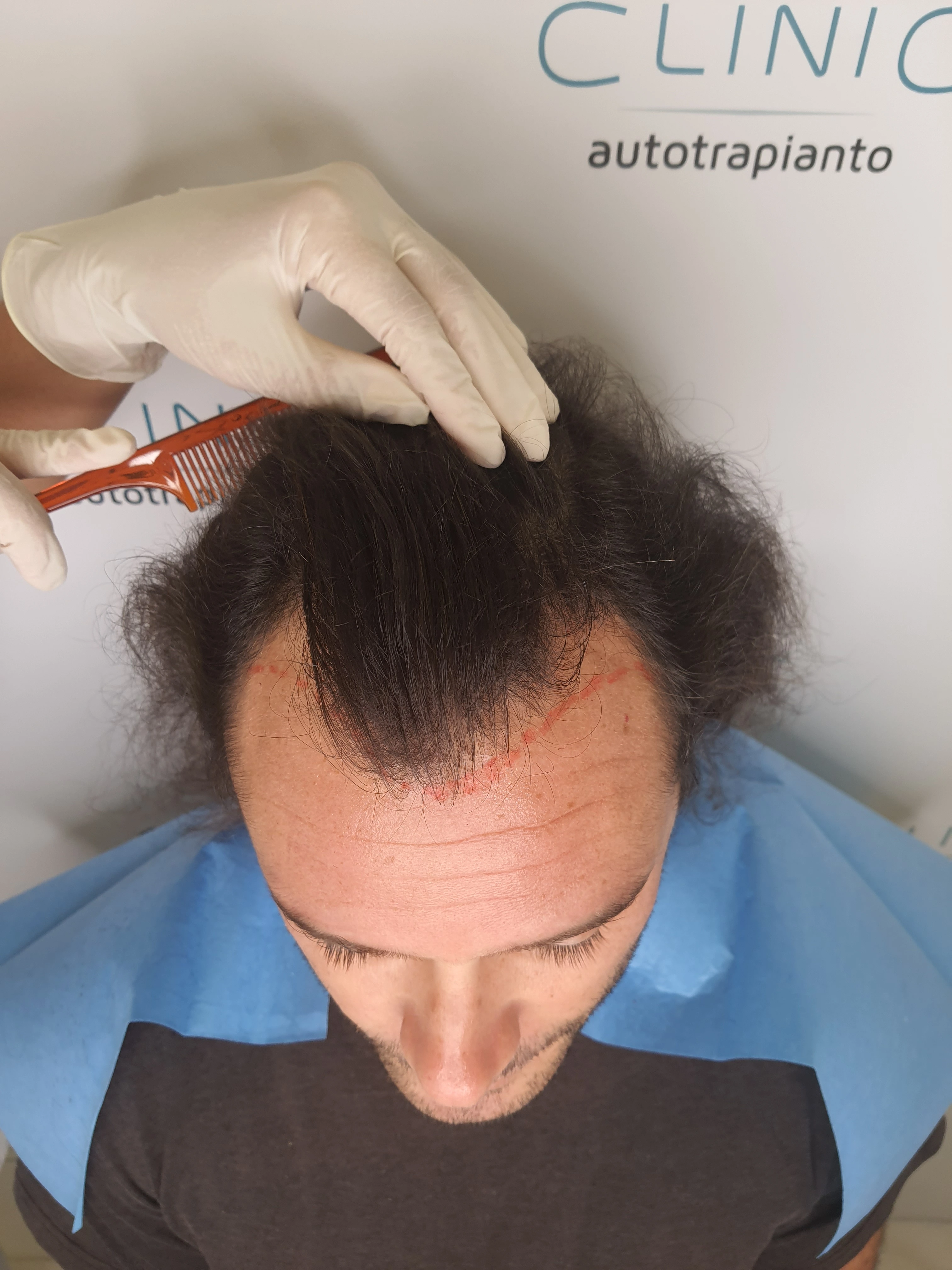 Dopo - Ricostruzione linea frontale e tempie